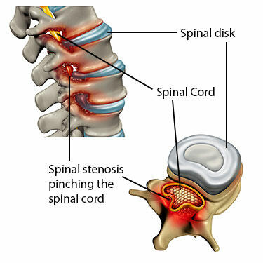 spinal-stenosis_0.jpg